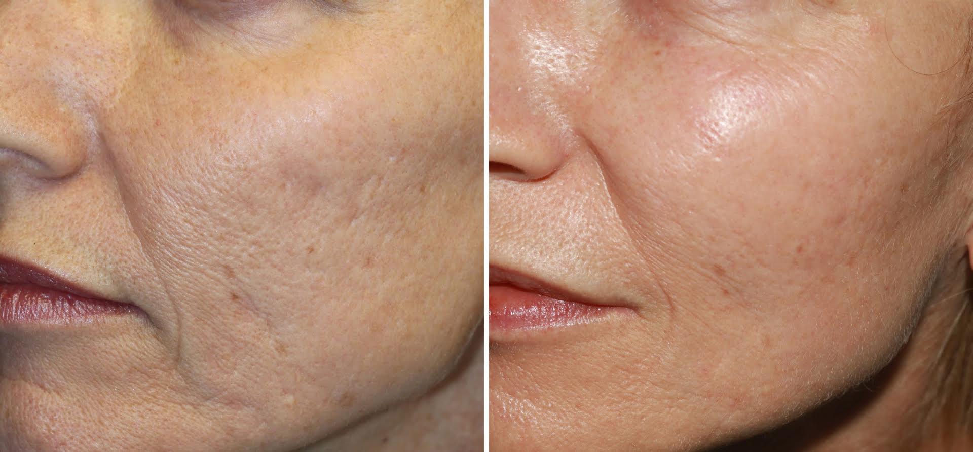 microneedling before and after photo